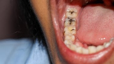 Image name: Open-Mouth-Teeth-Cavities-777x518.jpg
